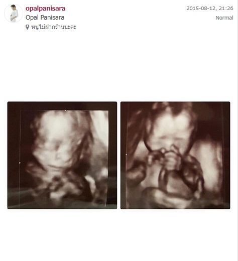 ภาพของน้องแฝด อลิน และอรัญ เมื่อครั้งอยู่ในท้องของคุณแม่โอปอร์